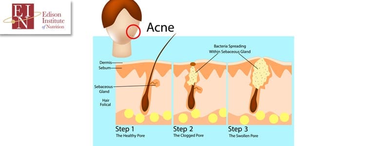Taking A Holistic Nutrition Approach To Acne | Online Nutrition Training Course & Diplomas | Edison Institute of Nutrition